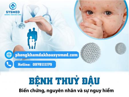 Hiểu Về Bệnh Thuỷ Đậu: Nguyên Nhân, Triệu Chứng, Biến chứng và Biện Pháp Phòng Ngừa